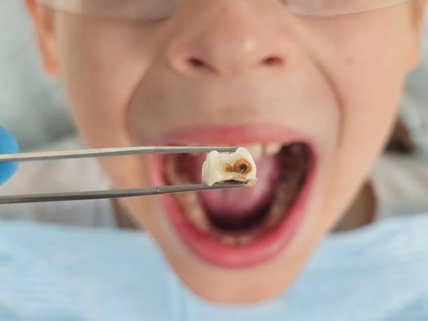 Best Emergency Tooth Extraction in , VA